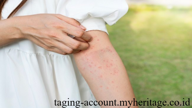 Solusi Efektif Mengatasi Alergi: Panduan Lengkap